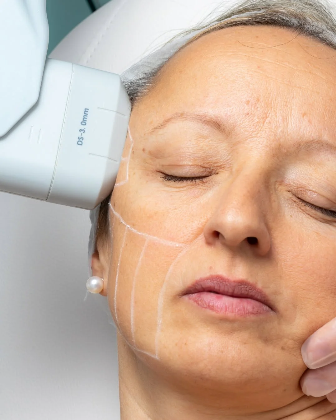HIFU facelift consultation